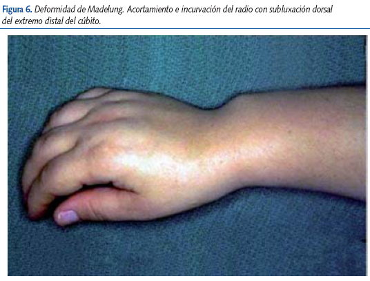 Figura 6. Deformidad de Madelung. Acortamiento e incurvación del radio con subluxación dorsal del extremo distal del cúbito.